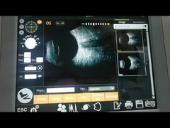 Fan Scan B Scan Machine 10MHz Observing Retinal Detachment
