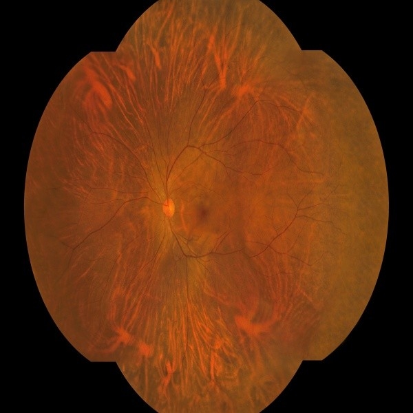 176 deg Wide Field Fundus Camera with AI Intelligent System and One Key Operation for Non-Mydriatic Single True Color Imaging