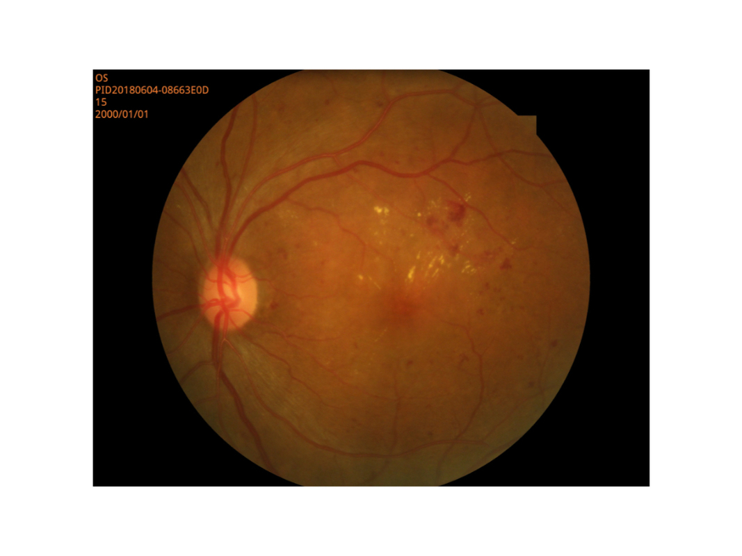 SYSEYE RetiCam 3100 Digital Fundus Camera with 1.3 Magnification 26.5Kg Weight and 90 mm Stage Movement for High Precision Retinal Imaging