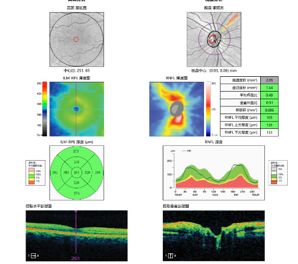 Posterior 3mm Optical Coherence Tomography Device For Retinal Diseases